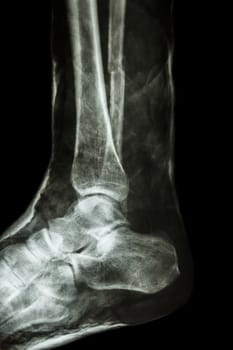 film x-ray fracture shaft of fibula(leg's bone) with cast