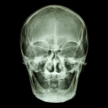 film x-ray skull AP : show normal old aged asian's skull (Thai people), (no tooth)