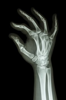 film x-ray human's hand and OK symbol