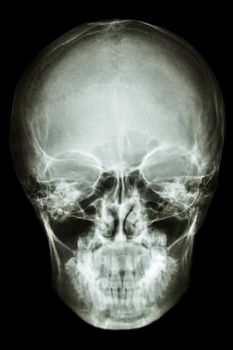 film x-ray asian people's skull (Thai people)