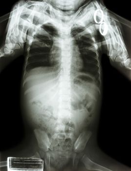 film x-ray body of infant and adult is holding at both shoulder of infant