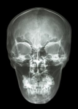 asian's skull (Thai people)