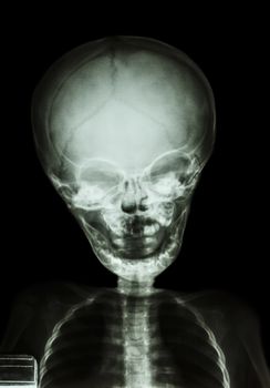 film x-ray skull and body of child