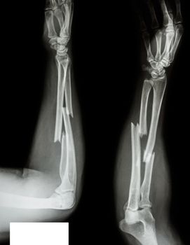 fracture shaft of radius & ulnar bone