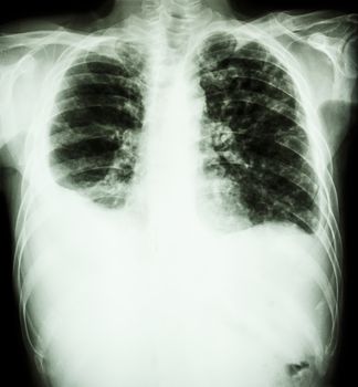 "Pulmonary Tuberculosis" film chest x-ray : Right pleural effusion and minimal left pleural effusion due to mycobacterium tuberculosis infection