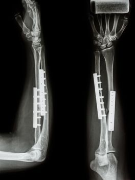 fracture shaft of radius & ulnar bone. It was operated and internal fixed by plate and screw