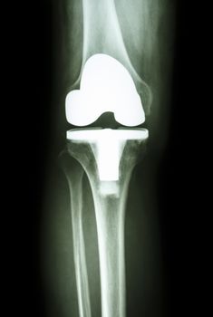 Knee joint prosthesis (Artificial joint) of osteoarthritis patient