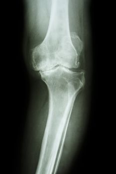 film x-ray knee AP of osteoarthritis knee patient (OA knee)