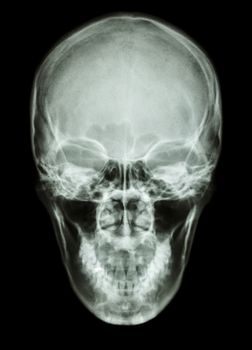 X-ray asian skull (Thai people)