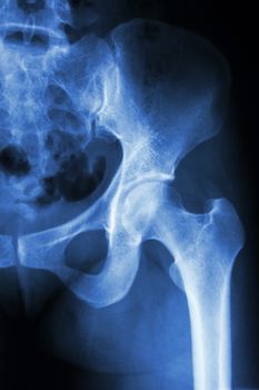 film x-ray left hip : show normal human's hip