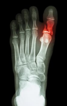 film x-ray show fracture proximal phalange at first toe