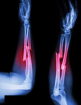 fracture shaft of radius & ulnar bone