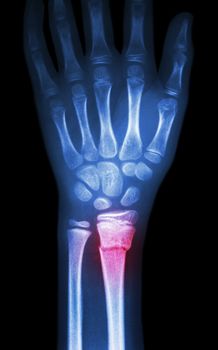 fiilm x-ray wrist show fracture distal radius (forearm's bone)