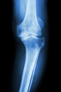 film x-ray knee AP of osteoarthritis knee patient (OA knee)