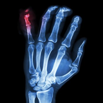 film x-ray hand AP : show fracture distal pharange little finger
