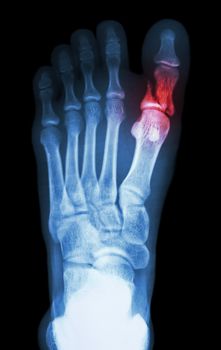 film x-ray show fracture proximal phalange at first toe