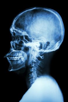 X-ray asian skull and cervical spine