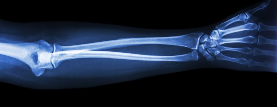 film x-ray forearm AP(antero-posterior)