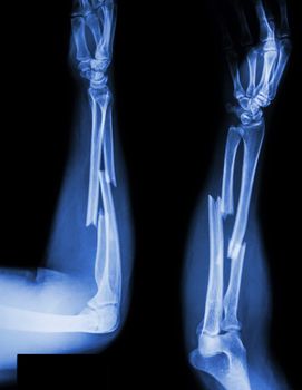 fracture shaft of radius & ulnar bone