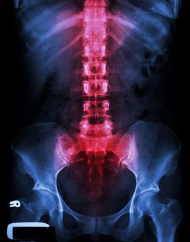 X-ray lumbo-sacral spine and pelvis and inflammation at spine