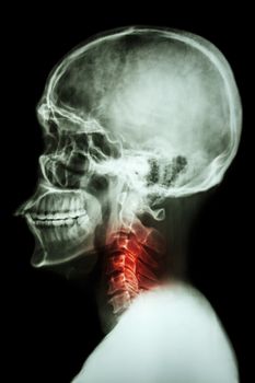 X-ray asian skull and cervical spine and neck pain