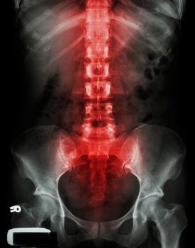 X-ray lumbo-sacral spine and pelvis and inflammation at spine