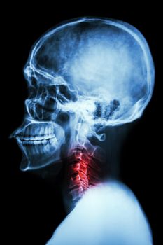 X-ray asian skull and cervical spine and neck pain