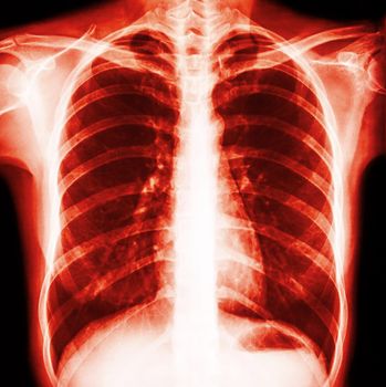 Film chest x-ray PA upright : show normal human's chest