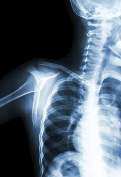 film x-ray transcapula Y view : show normal child's shoulder