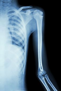 film x-ray left shoulder