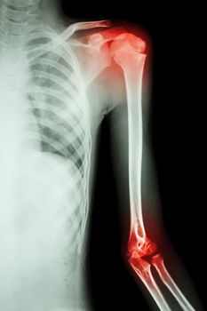 film x-ray left shoulder and arthritis at shoulder and elbow