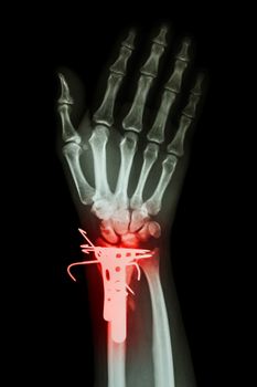 film x-ray wrist AP : show fracture distal radius (forearm's bone). It was operated and inserted plate and K-wire(Kirschner wire)