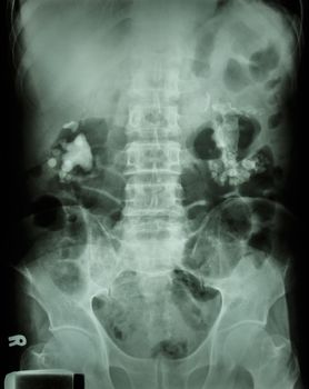 Bilateral renal calculi(staghorn)