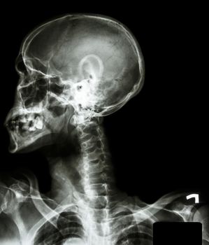 X-ray asian skull(thai people),cervical spine,both shoulder and blank area at right side