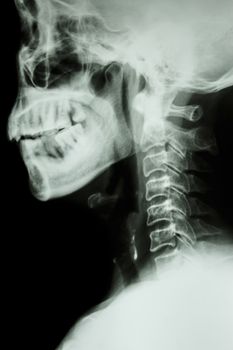 X-ray cervical spine of asian people