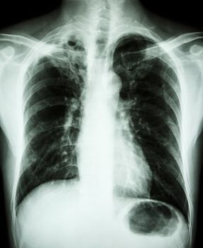 "Pulmonary Tuberculosis" Film chest x-ray : cavity and interstitial infiltration at right upper lung due to Mycobacterium tuberculosis infection