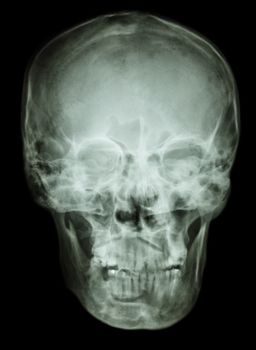 film skull AP(antero-posterior) show normal human skull