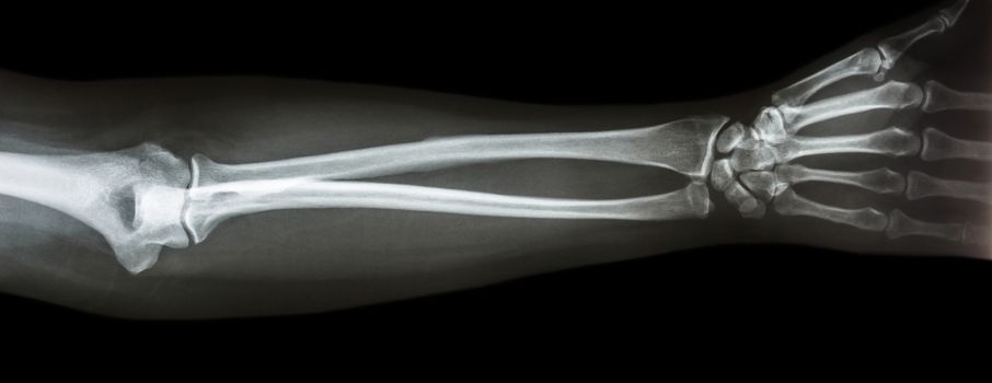 film x-ray forearm AP(antero-posterior)