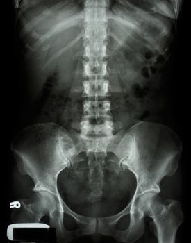 X-ray lumbo-sacral spine and pelvis of asian adult people