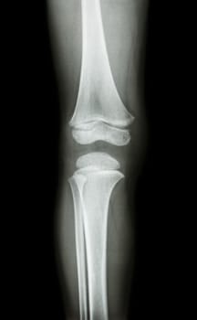 film x-ray knee AP(antero-posterior) of child