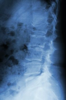 Film x-ray lumbar spine lateral : show burst fracture at lumbar spine (collapse at body of lumbar spine)