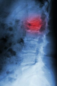 Film x-ray lumbar spine lateral : show burst fracture at lumbar spine (collapse at body of lumbar spine)