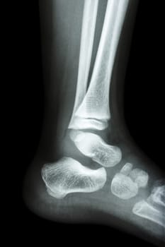 Film x-ray normal child's ankle