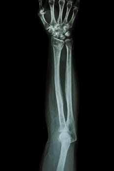 Fracture distal radius (wrist bone) ,(Colles' fracture)