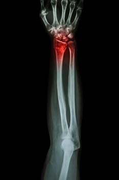 Fracture distal radius (wrist bone) ,(Colles' fracture)