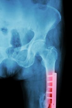 Film X-ray fracture femur(Thigh bone). It was operated and internal fixed by plate & screw