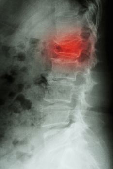 Film x-ray lumbar spine lateral : show burst fracture at lumbar spine (collapse at body of lumbar spine)