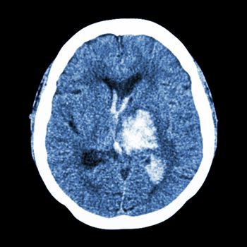 CT brain : show left thalamic hemorrhage (Hemorrhagic stroke)