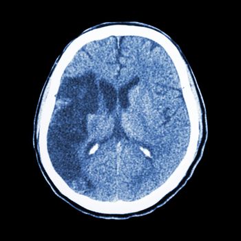 CT brain : show Ischemic stroke (hypodensity at right frontal-parietal lobe)