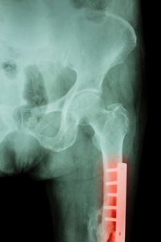 Film X-ray fracture femur(Thigh bone). It was operated and internal fixed by plate & screw